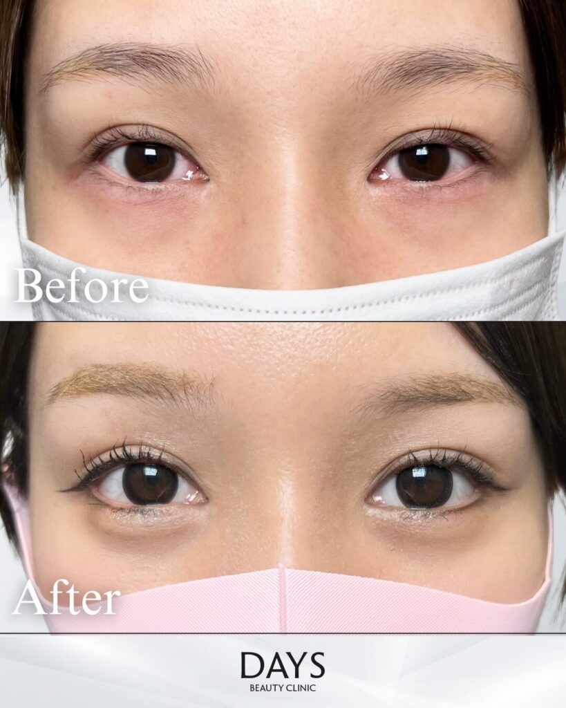 グラマラスライン形成　症例　20代女性