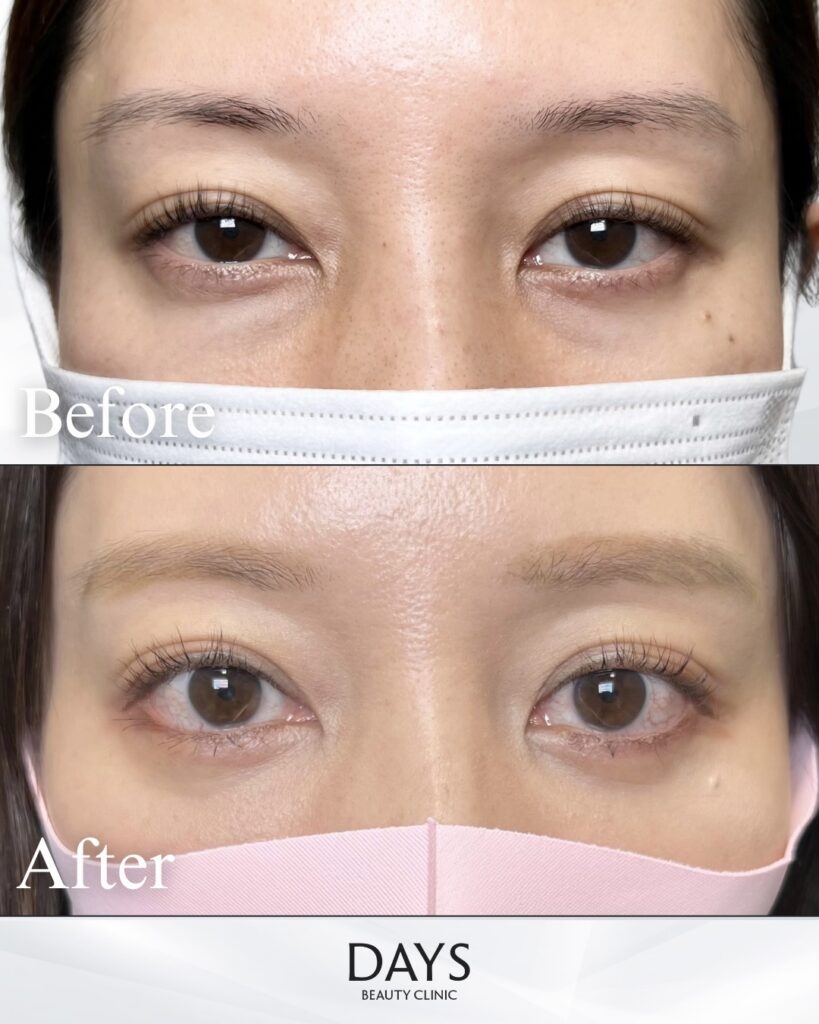 タレ目形成　症例　20代女性