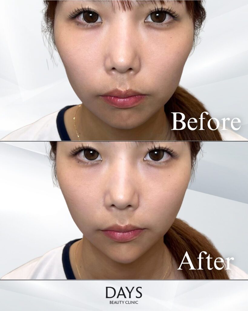 頬/顎ヒアルロン酸　症例　20代女性