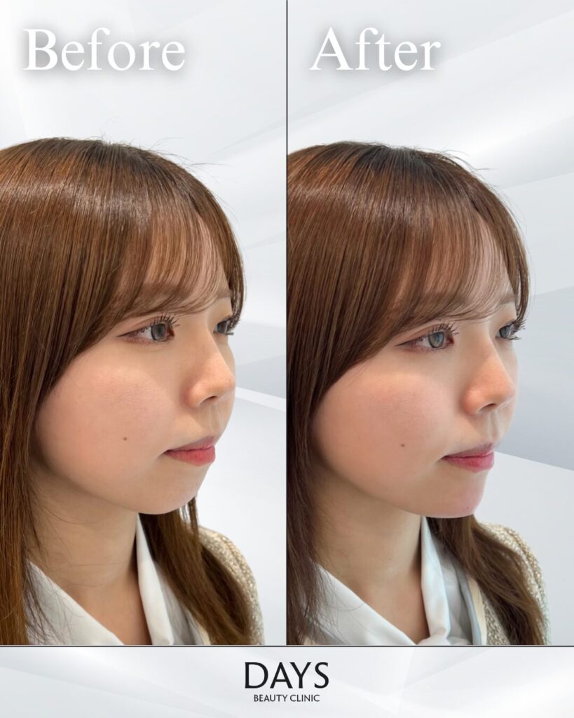 顎ヒアルロン酸　症例　20代女性