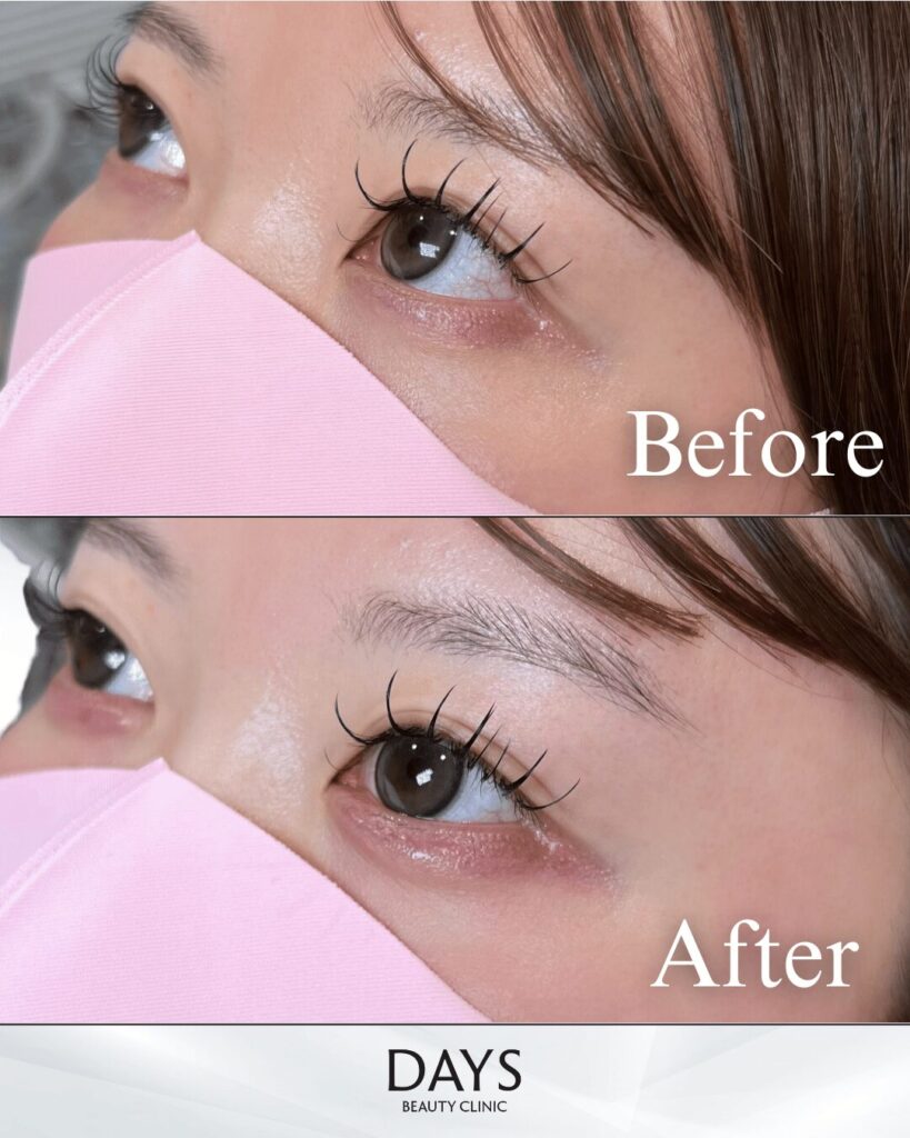 涙袋ヒアルロン酸　症例　２０代女性