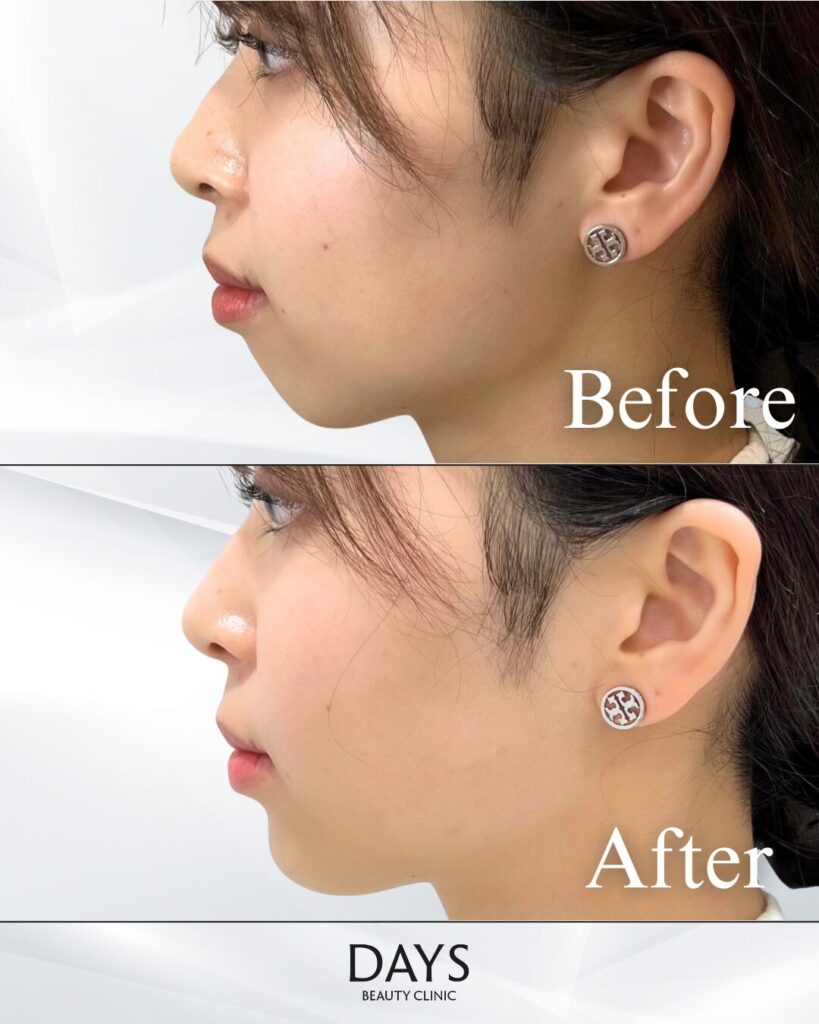 顎ヒアルロン酸　症例　20代女性