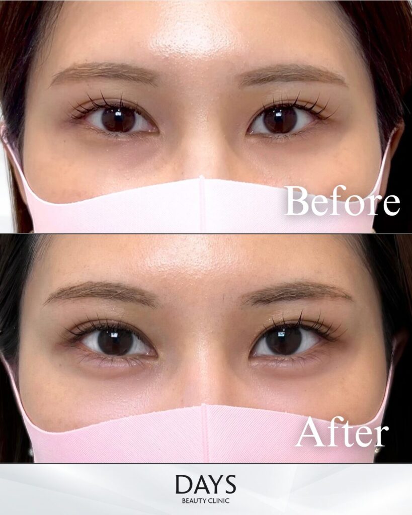 涙袋ヒアルロン酸　症例　20代女性