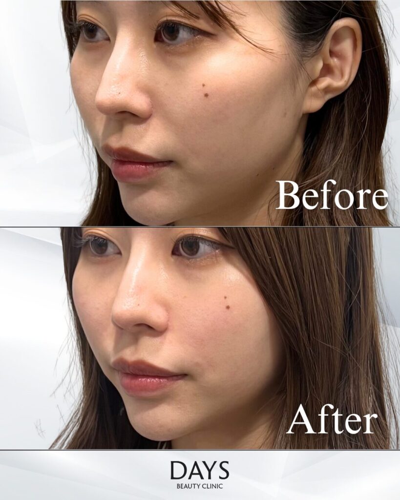 鼻翼基部のヒアルロン酸　症例　20代女性