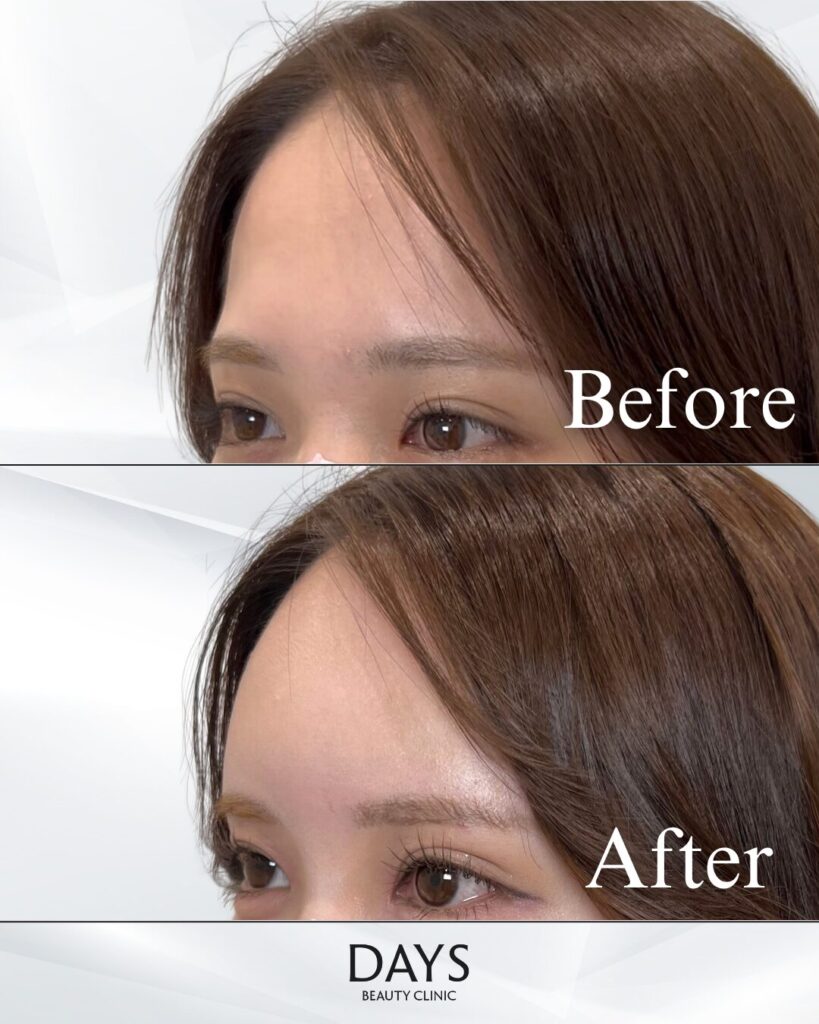 額ヒアルロン酸　症例　20代女性