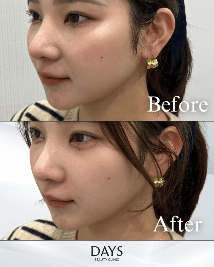 涙袋/ほうれい線ヒアルロン酸　症例　２０代女性