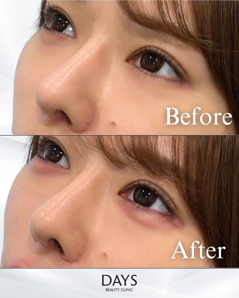 涙袋ヒアルロン酸　症例　20代女性