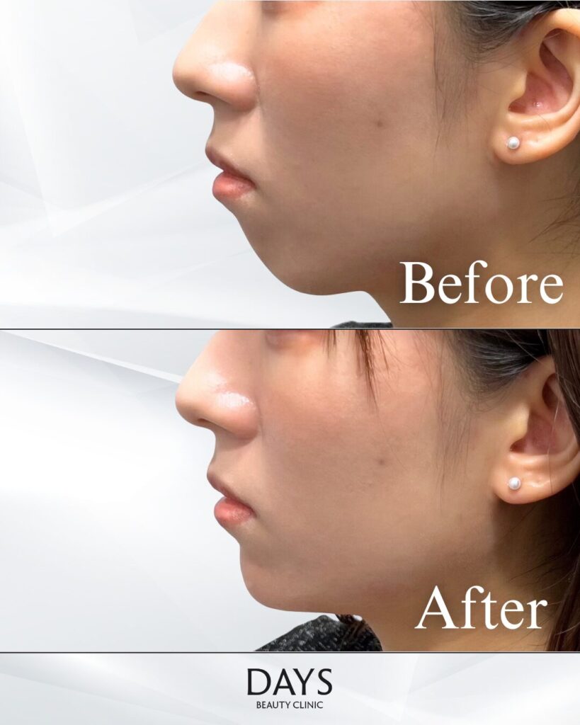 顎ヒアルロン酸　症例　20代女性