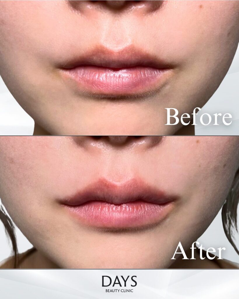 唇ヒアルロン酸　症例　20代女性