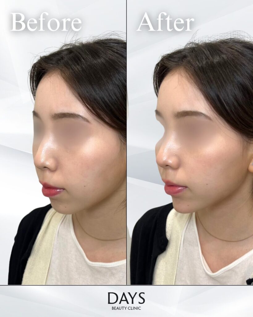 顎ヒアルロン酸　症例　20代女性
