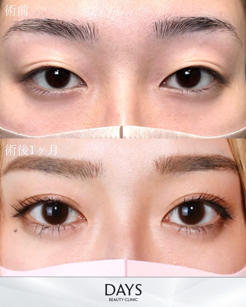 二重埋没　症例　30代女性