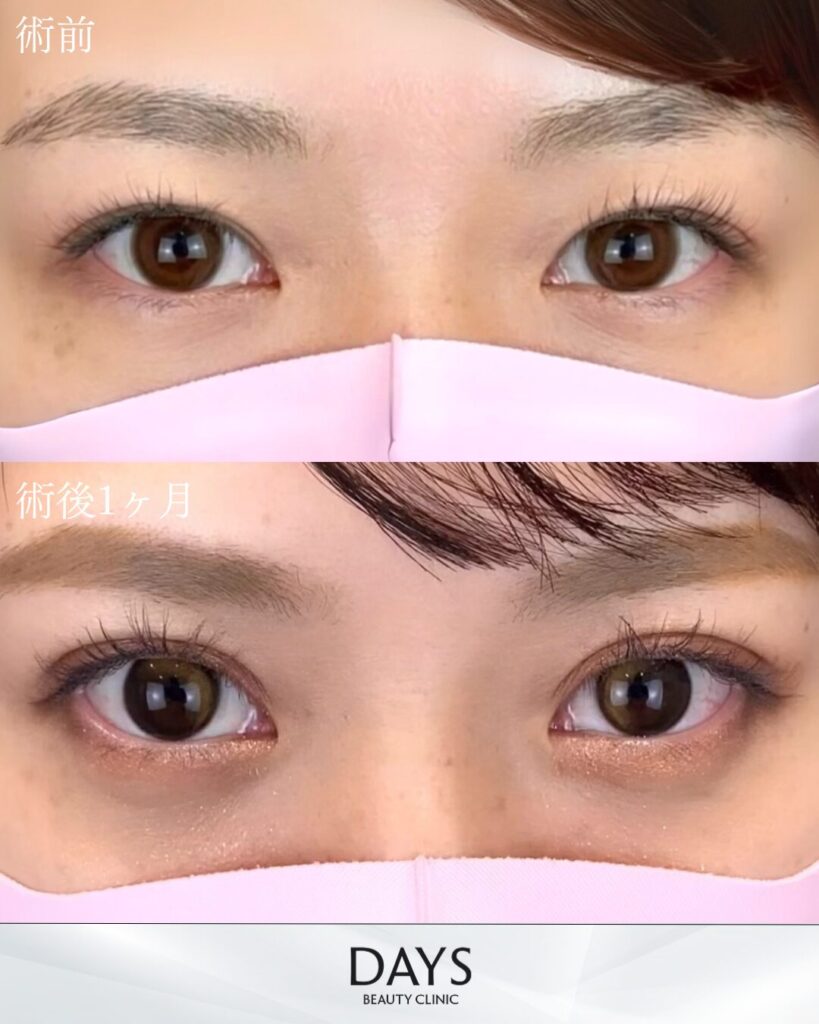 二重埋没　症例　20代女性