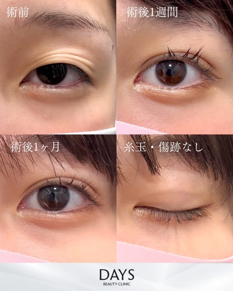 二重埋没　症例　20代女性