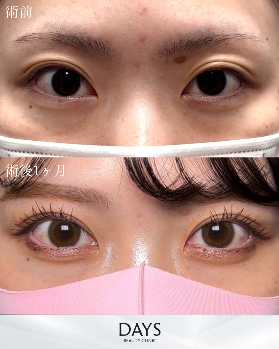 二重埋没　症例　20代女性