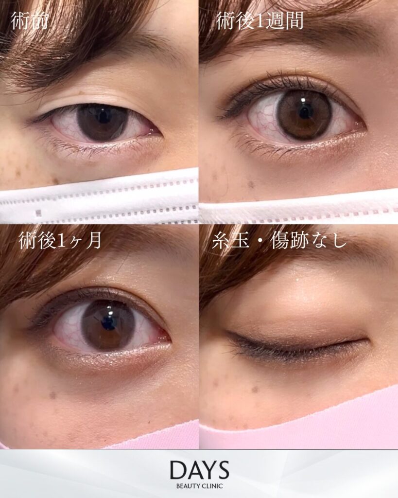 二重埋没　症例　20代女性