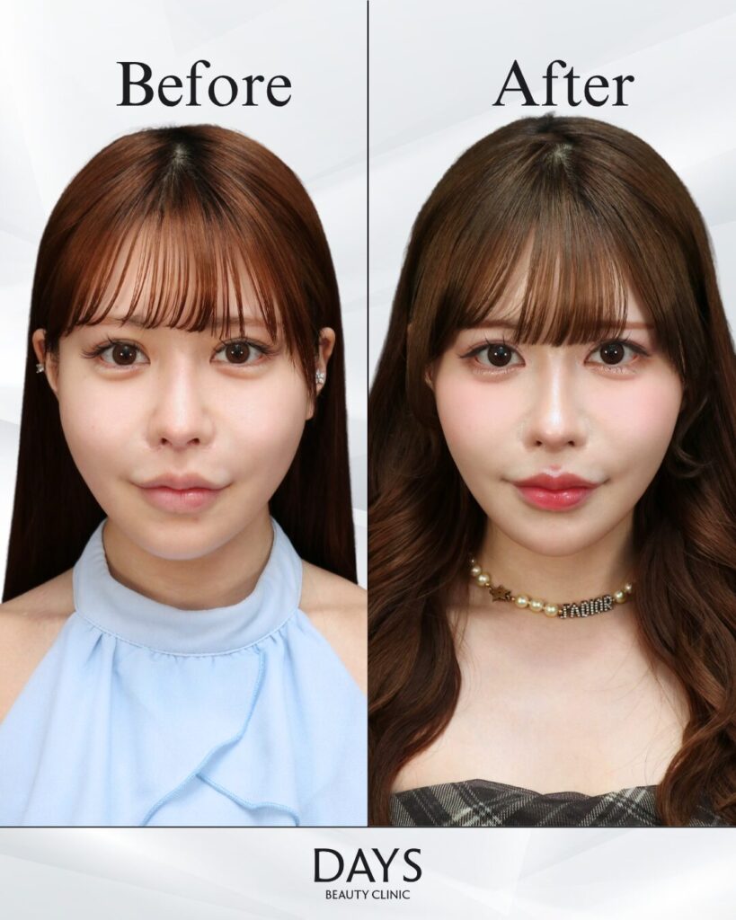 小顔　症例　20代女性