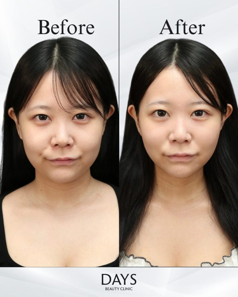 小顔　症例　20代　女性