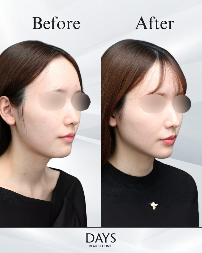 小顔　症例　20代女性