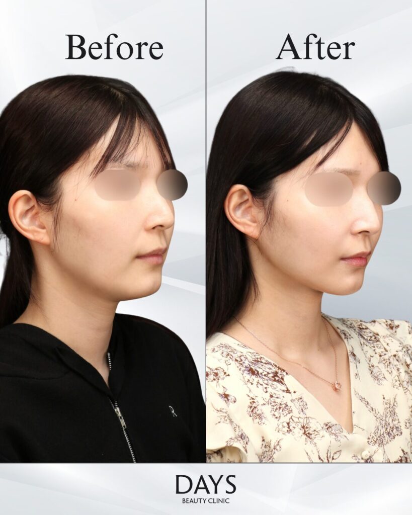 小顔　症例　20代女性