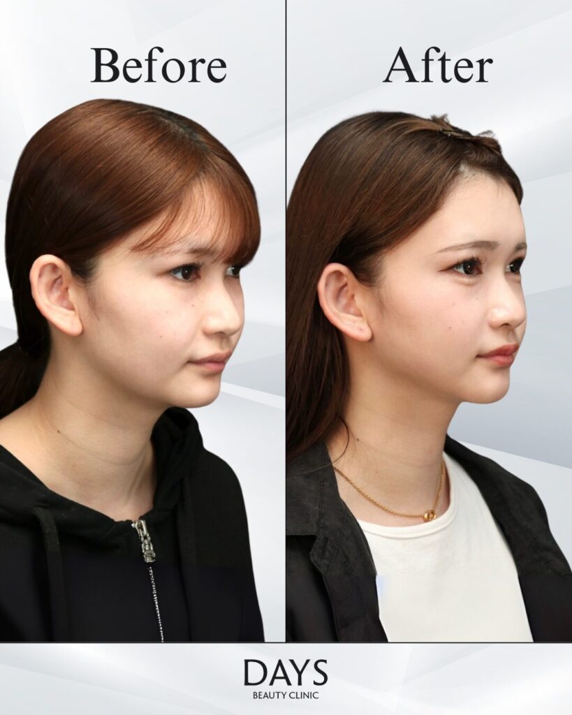 小顔　症例　20代女性