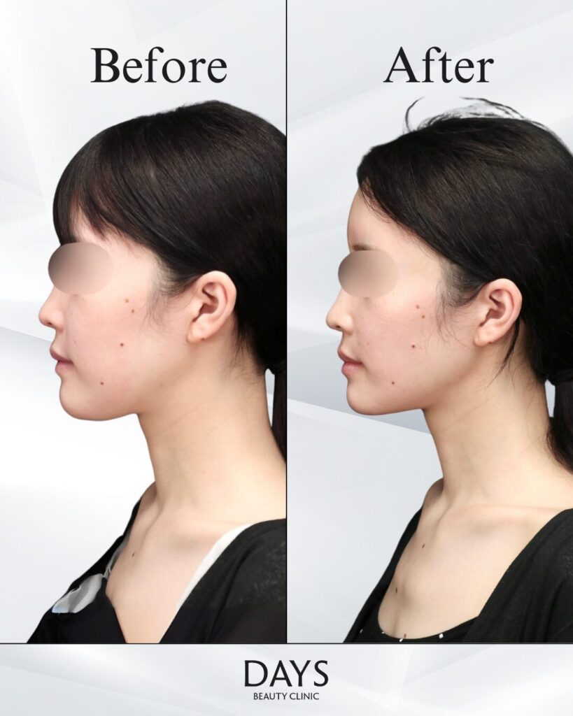 小顔　症例　20代女性