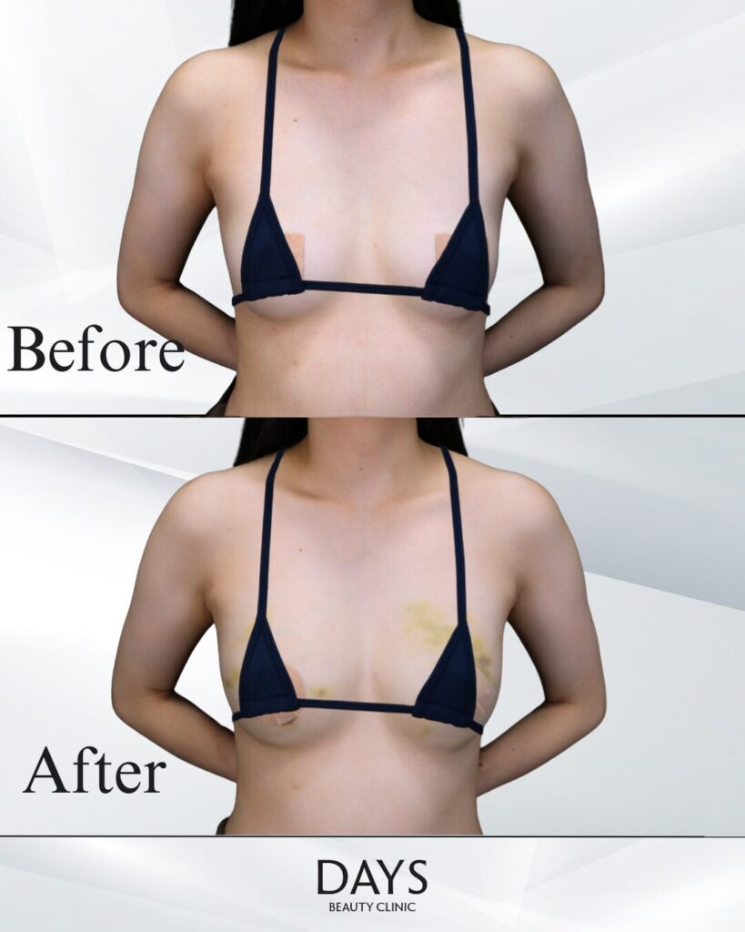 脂肪豊胸　症例　20代女性