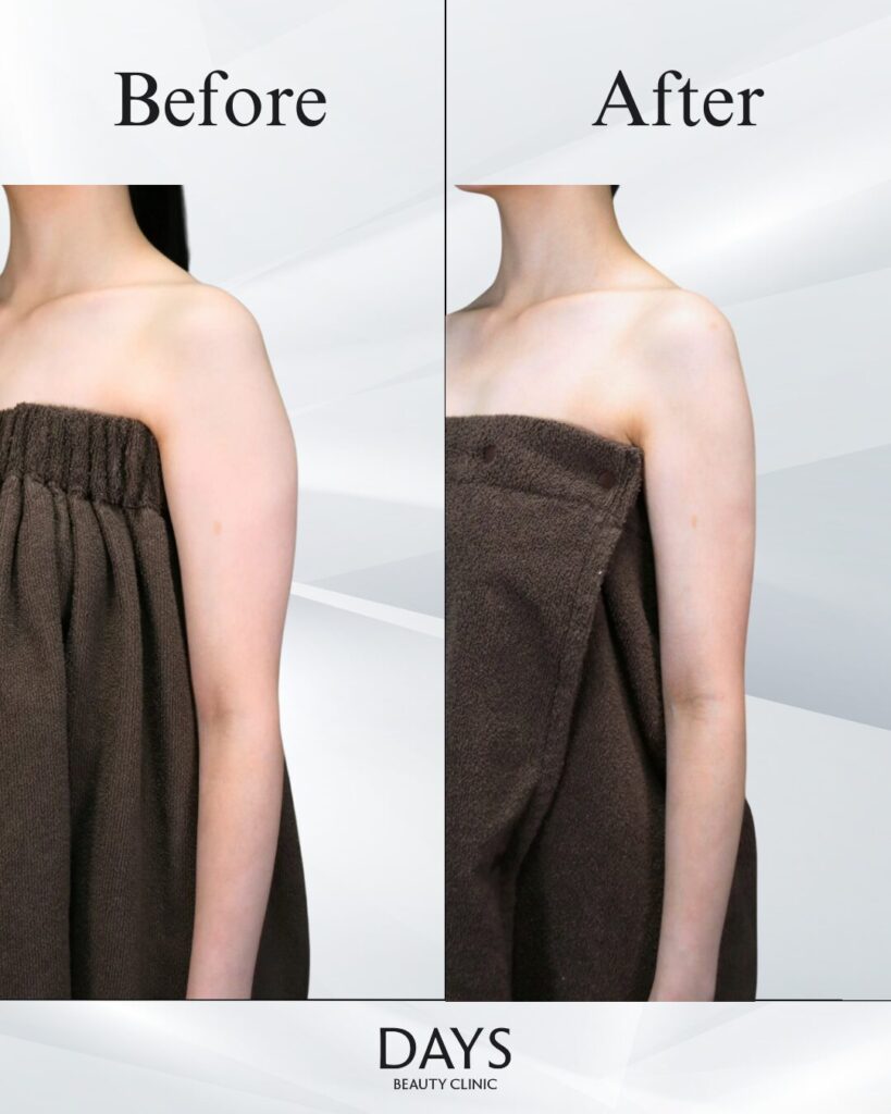 二の腕脂肪吸引　症例　20代女性