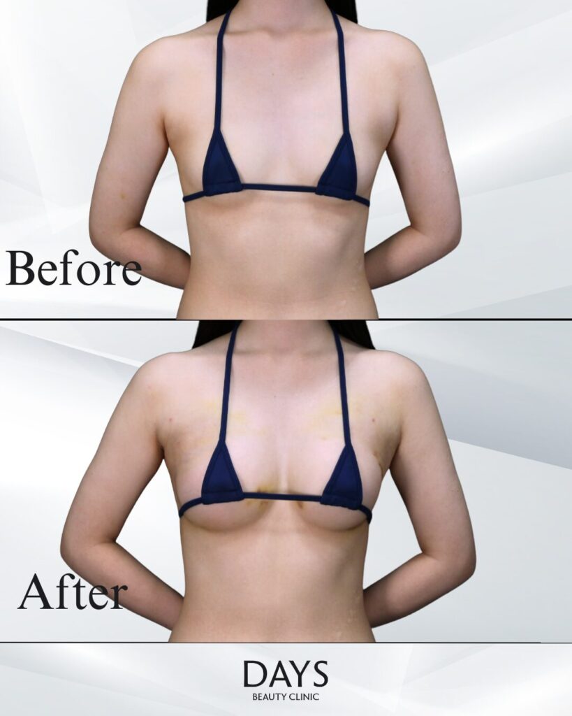 ハイブリッド豊胸　症例　20代女性