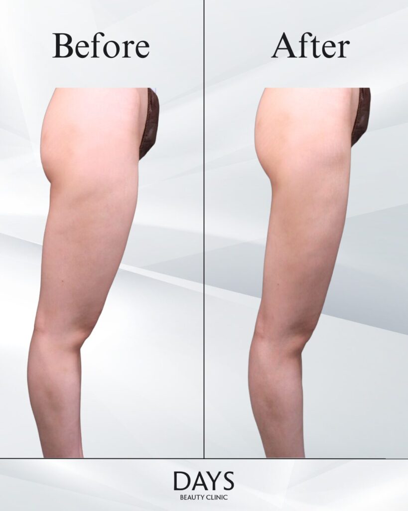 太もも脂肪吸引　症例　20代女性