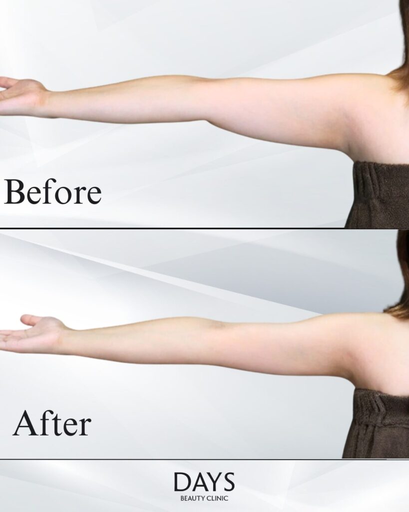 二の腕脂肪吸引　症例　20代女性