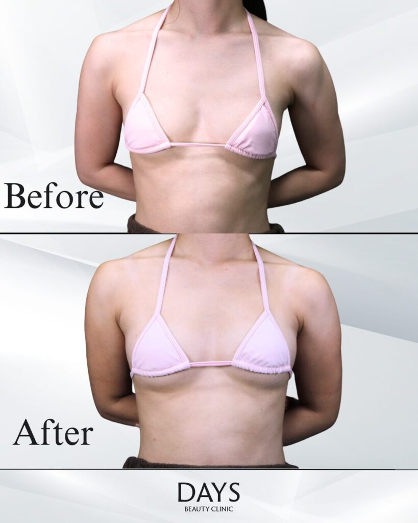 脂肪豊胸　症例　２０代女性