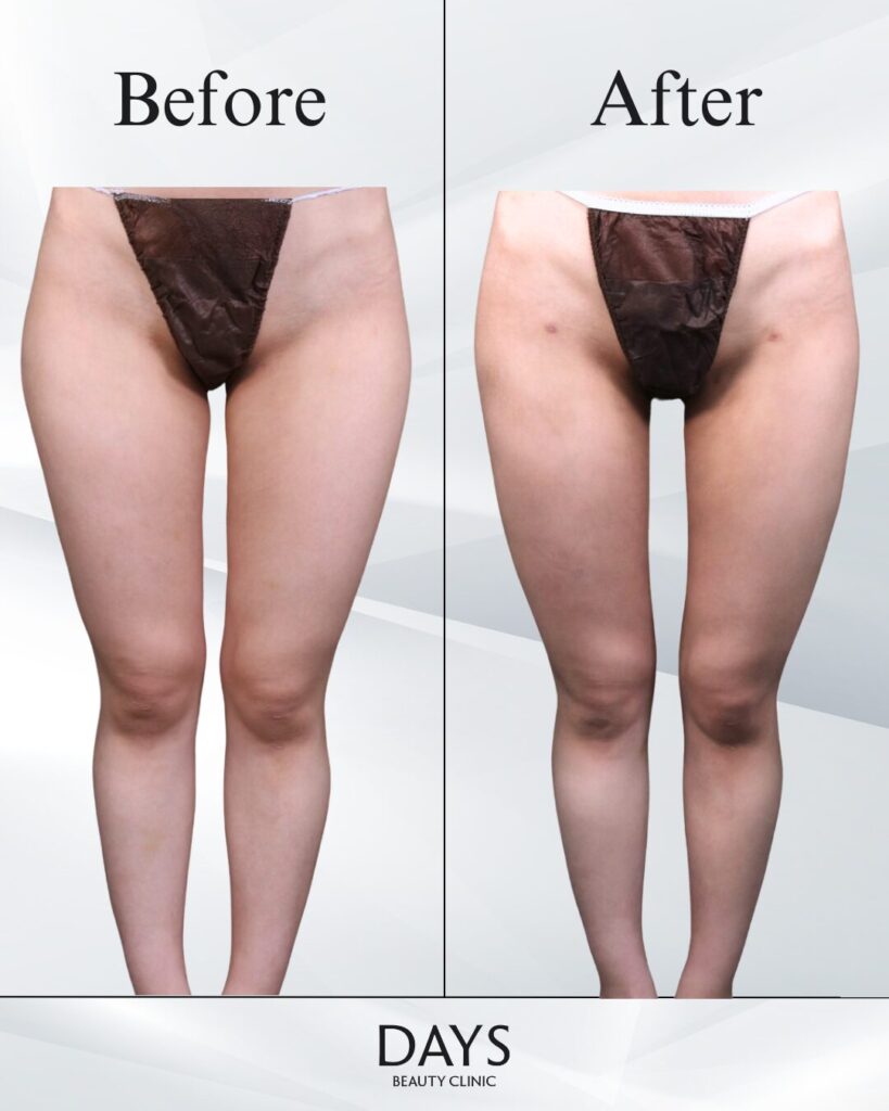 太もも脂肪吸引　症例　20代女性