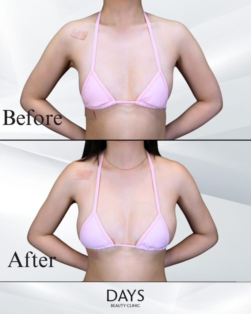 脂肪豊胸　症例　20代女性