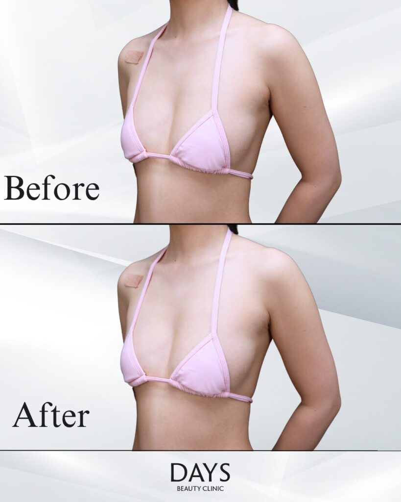 脂肪豊胸　症例　20代女性