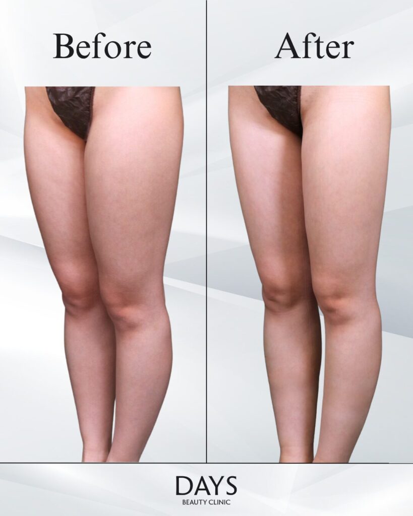 太もも脂肪吸引　症例　20代女性