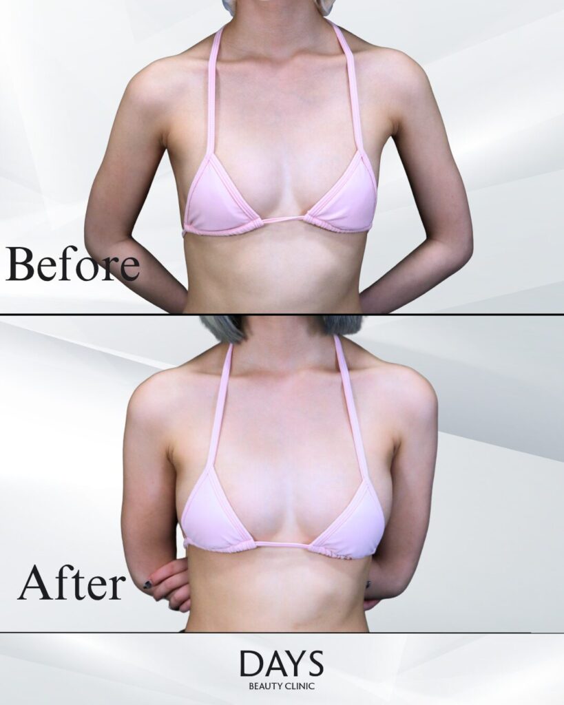 脂肪豊胸　症例　20代女性