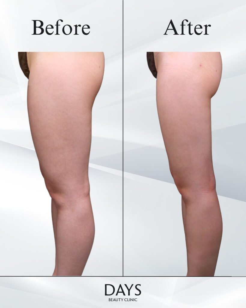 太もも脂肪吸引　症例　20代女性