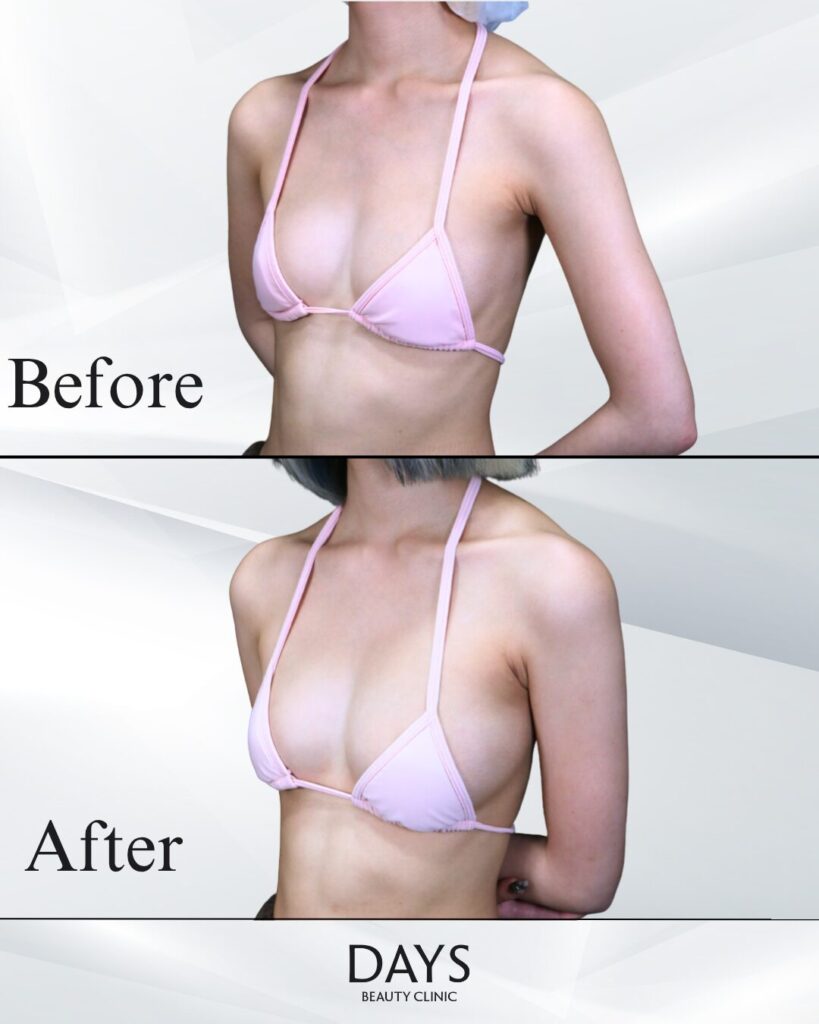 脂肪豊胸　症例　20代女性