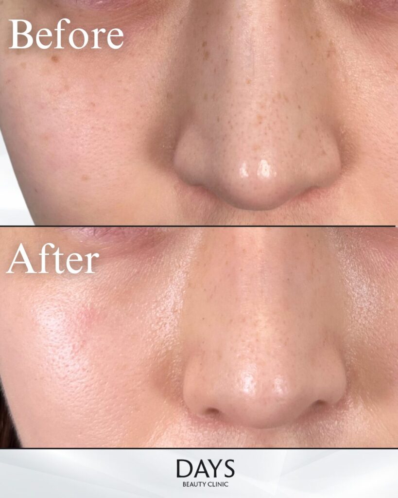 ピコスポット-の症例　20代女性