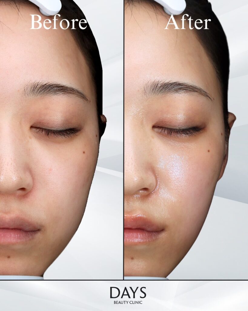 ジャルプロスーパーハイドロ　症例　20代女性