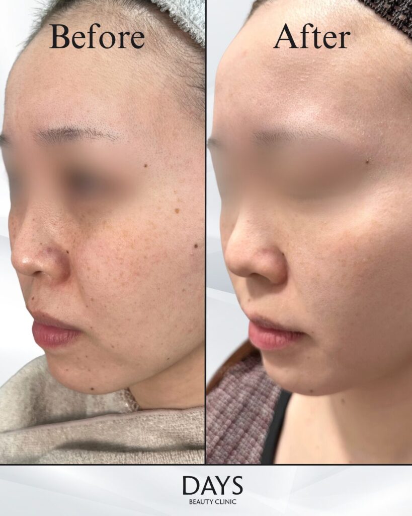 ピコスポット-の症例　20代女性