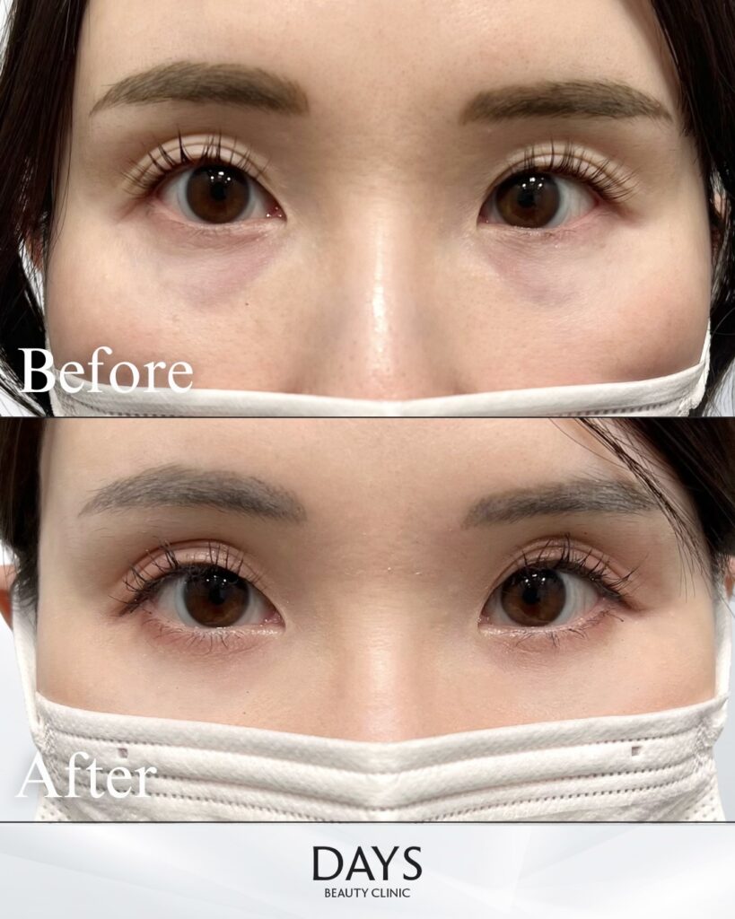 クマ取り　症例　30代女性