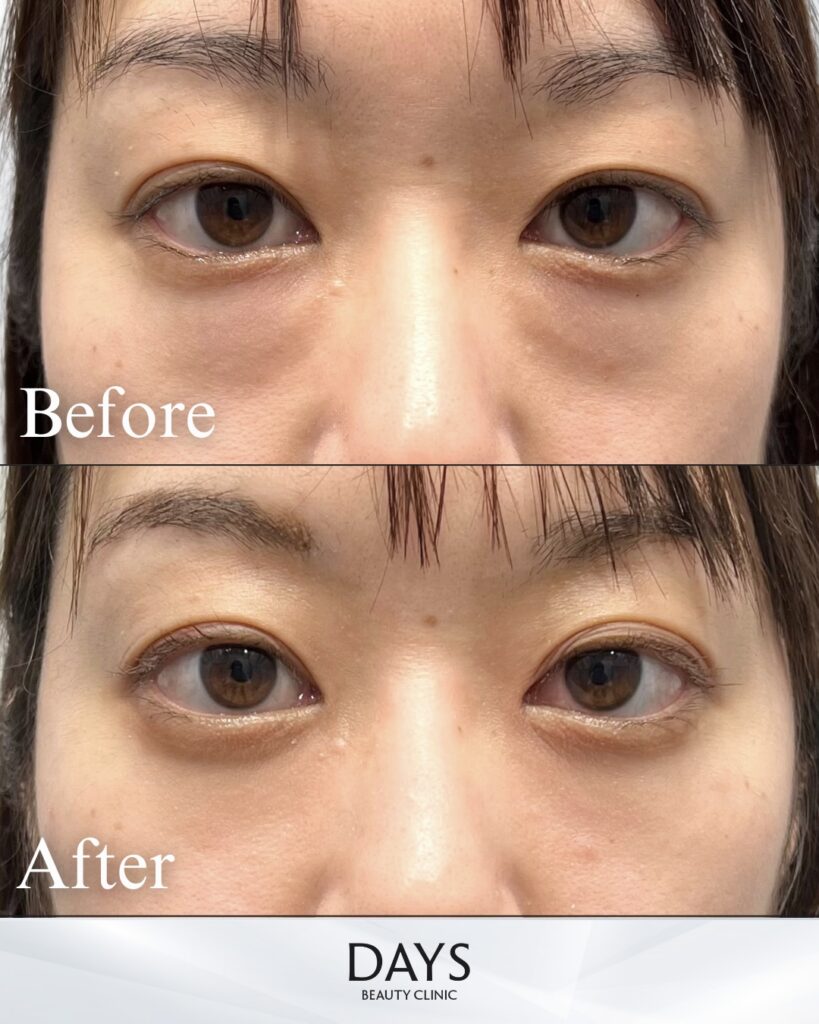 クマ取り　症例　３０代女性