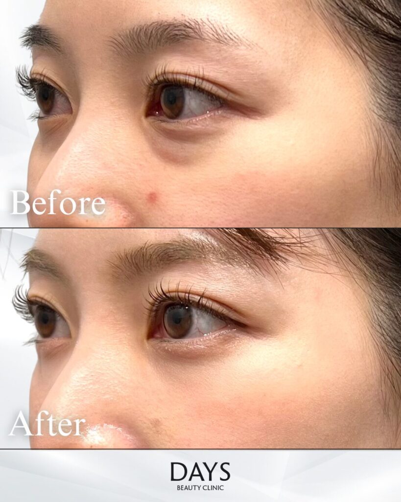 クマ取り　症例　２０代女性