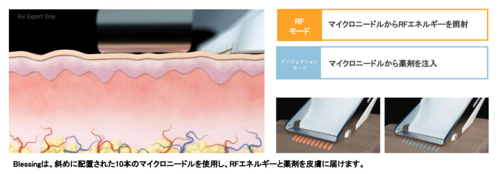ブレッシングの仕組み
