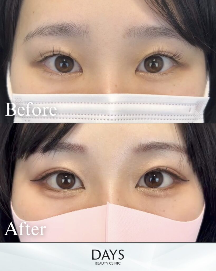 タレ目形成　症例　20代女性