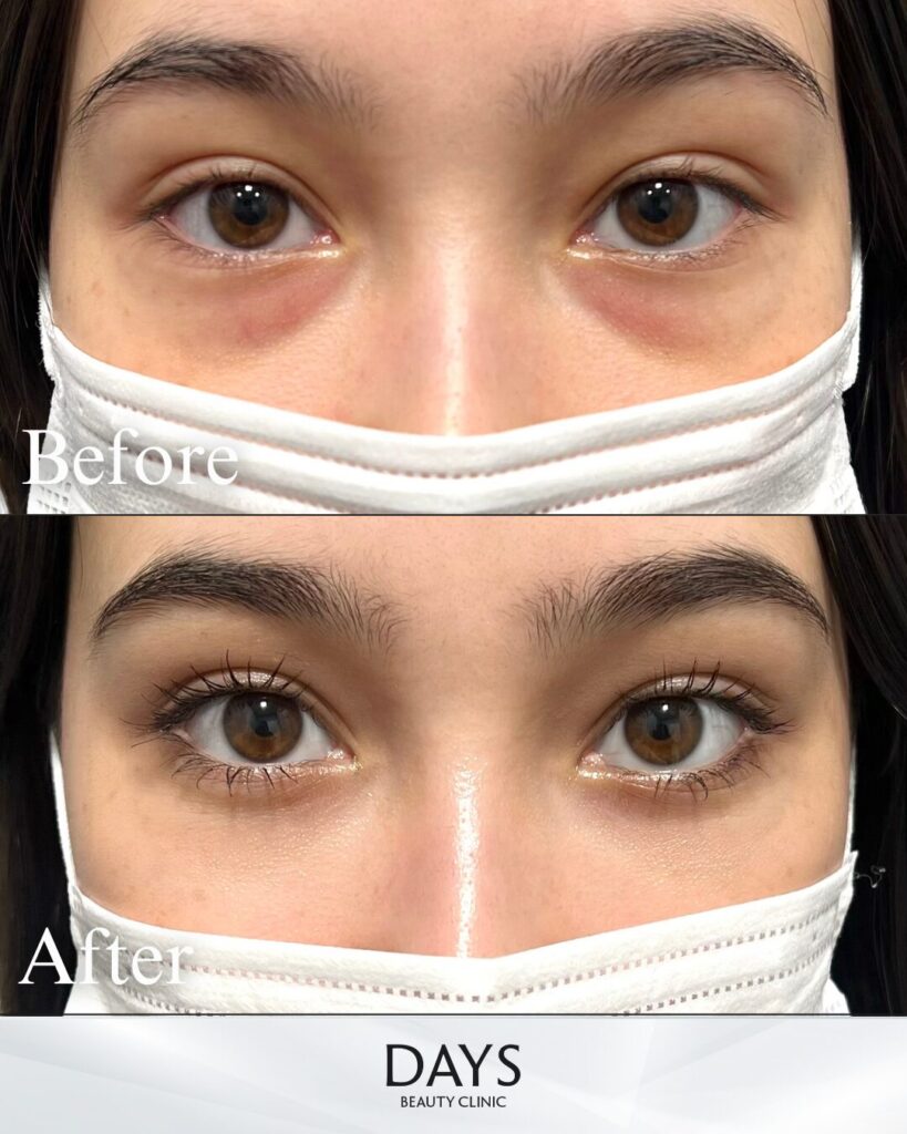 クマ取り　症例　20代　女性