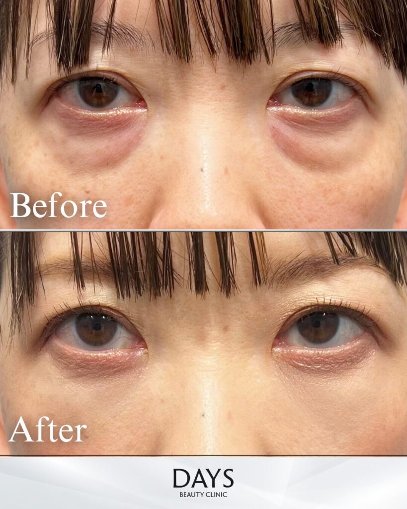 クマ取り　症例　30代女性