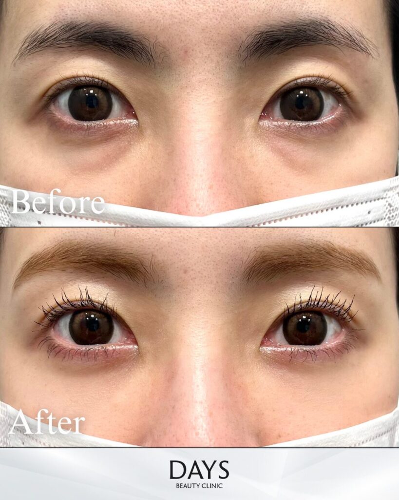 クマ取り　症例　３０代女性