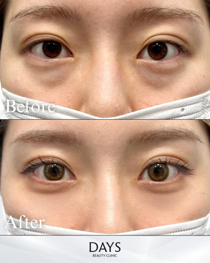 裏ハムラ　症例　20代女性